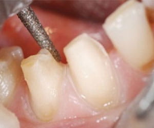 DENTIST Tooth Preparation